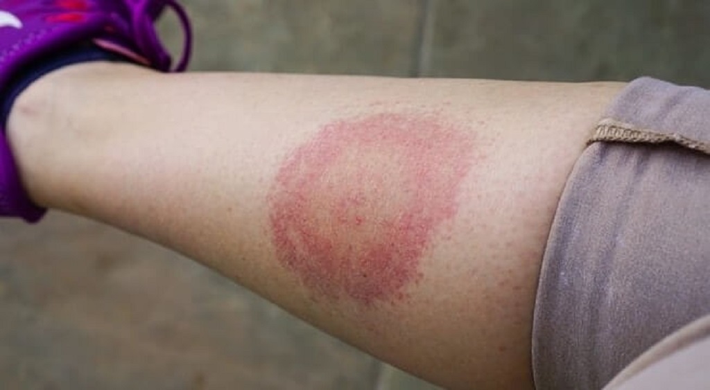 Why do I react so badly to mosquito bites